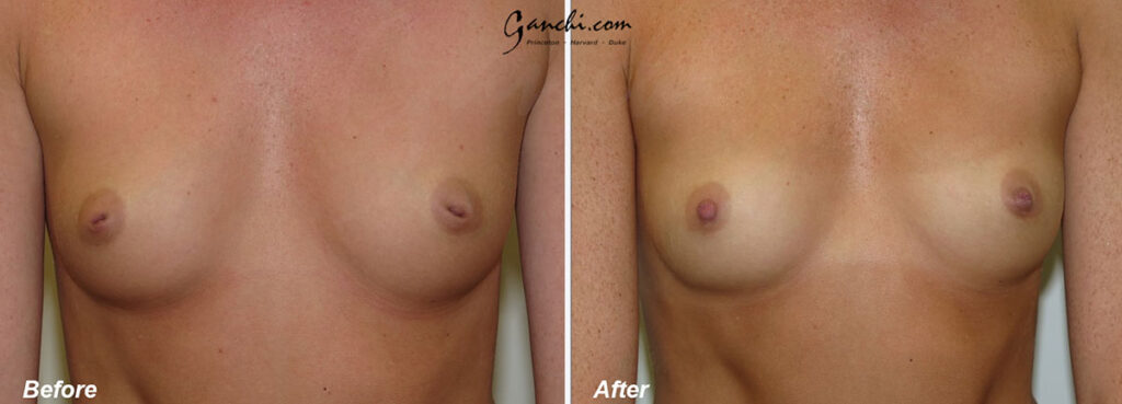 Nipple Surgery Before and After Photo by Ganchi Plastic Surgery in Northern New Jersey