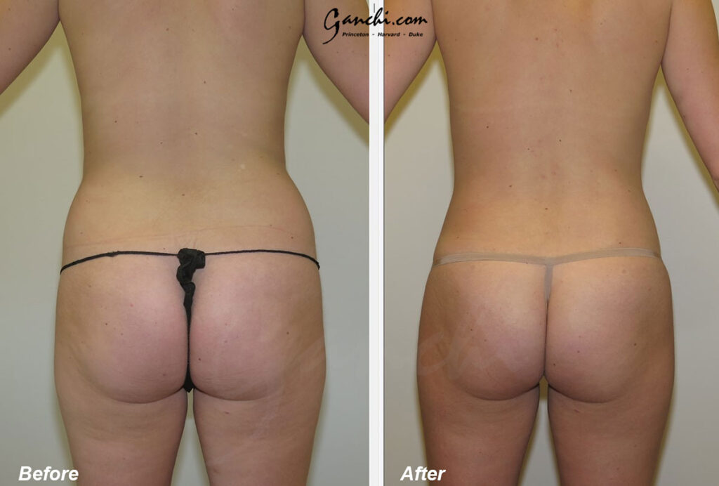 Liposuction Before and After Photo by Ganchi Plastic Surgery in Northern New Jersey