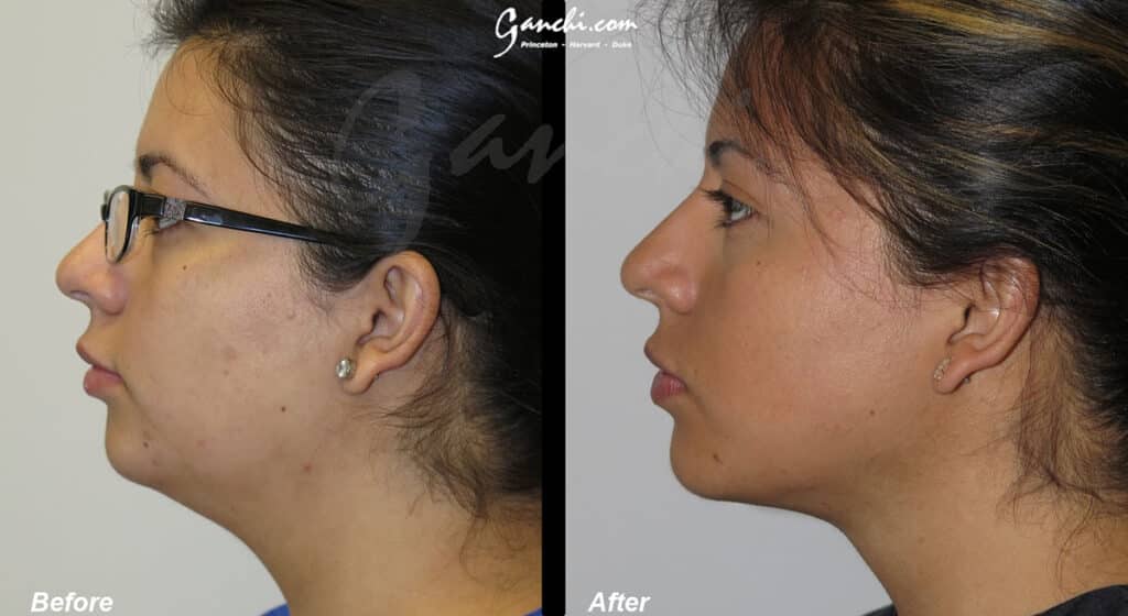 Neck Liposuction Before and After Photo by Ganchi Plastic Surgery in Northern New Jersey
