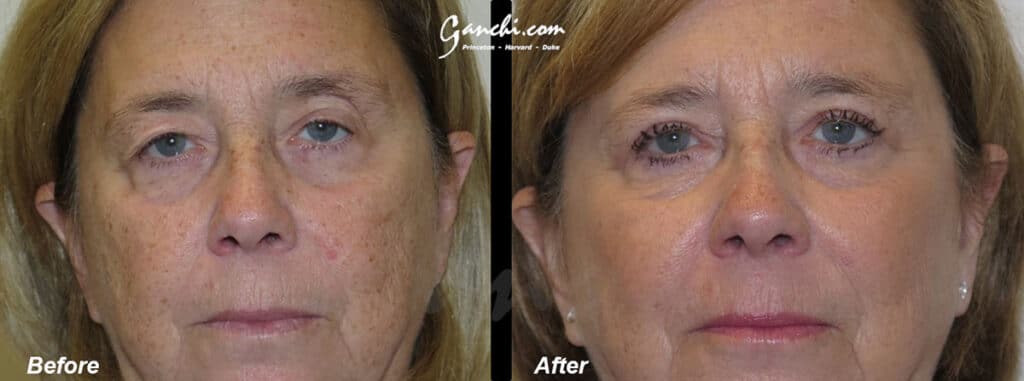 Eyelid Lift Before and After Photo by Ganchi Plastic Surgery in Northern New Jersey