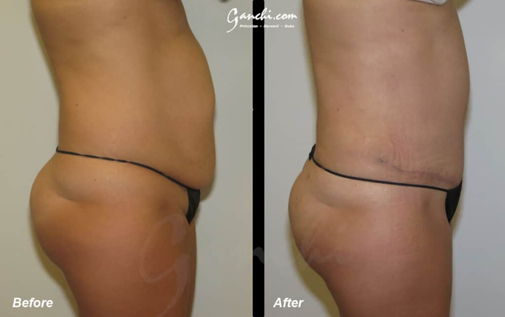 Tummy Tuck Before and After Photo by Ganchi Plastic Surgery in Northern New Jersey
