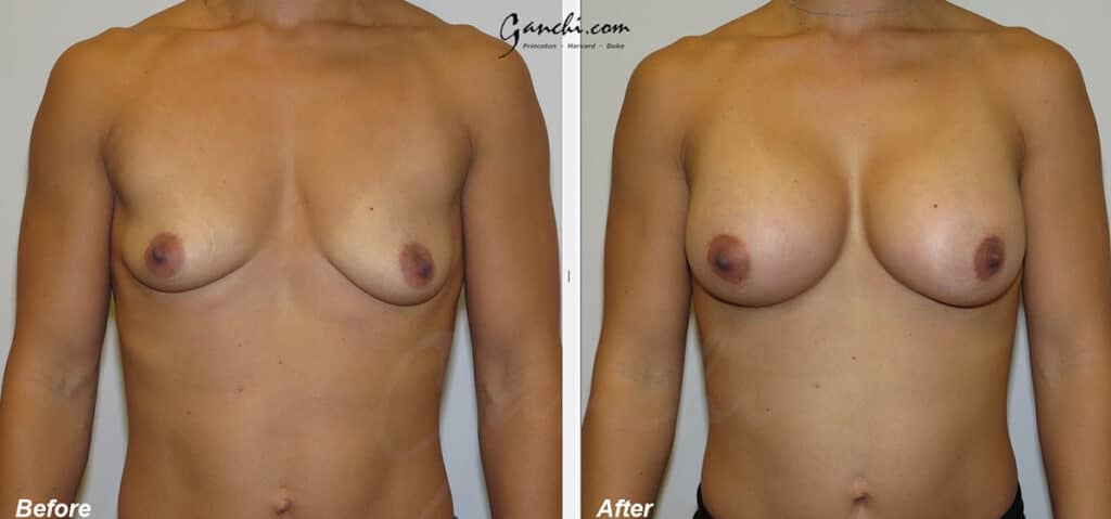 Breast Augmentation Before and After Photo by Ganchi Plastic Surgery in Northern New Jersey