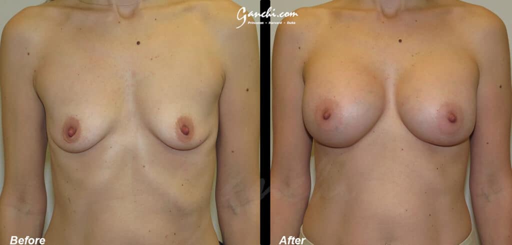 Breast Augmentation Before and After Photo by Ganchi Plastic Surgery in Northern New Jersey