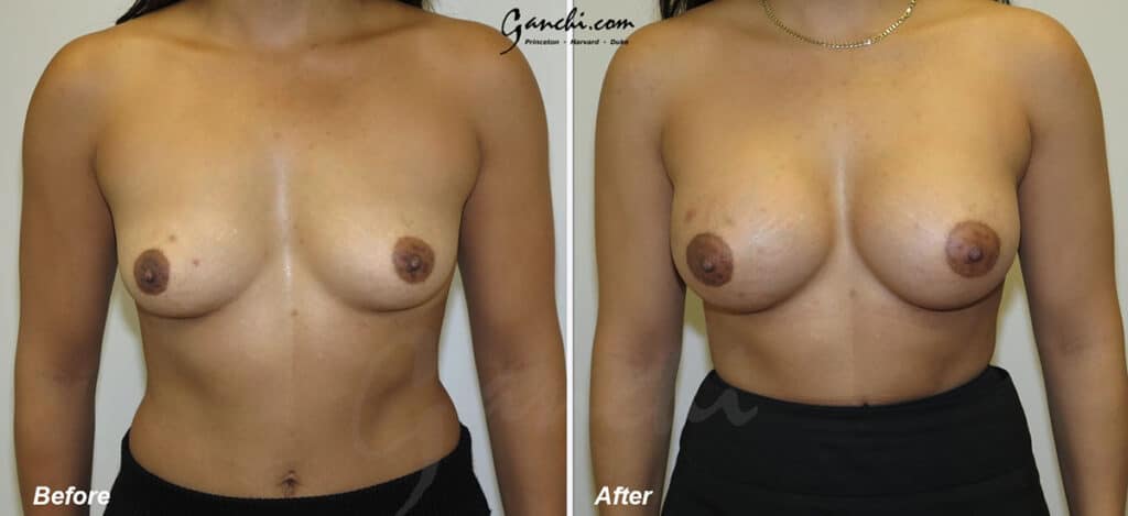 Breast Augmentation Before and After Photo by Ganchi Plastic Surgery in Northern New Jersey 1