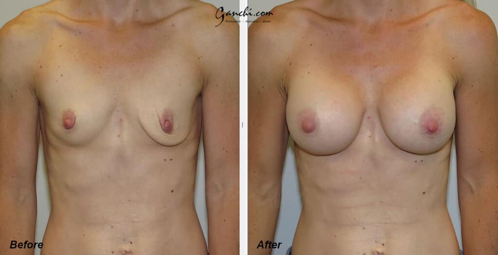 Breast Augmentation Before and After Photo by Ganchi Plastic Surgery in Northern New Jersey