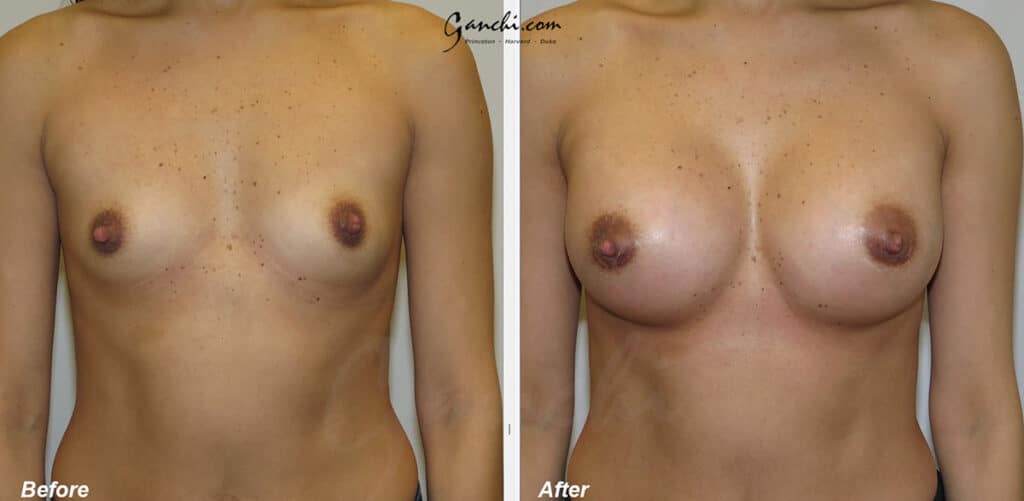 Breast Augmentation Before and After Photo by Ganchi Plastic Surgery in Northern New Jersey