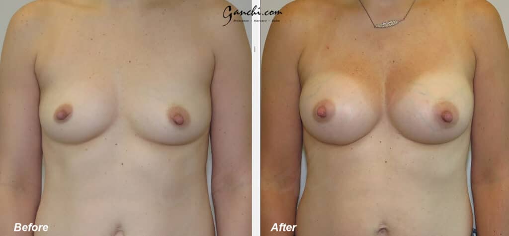 Breast Augmentation Before and After Photo by Ganchi Plastic Surgery in Northern New Jersey