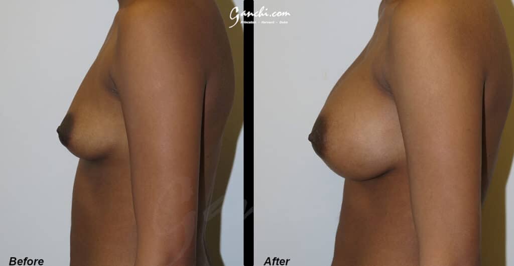 Breast Augmentation Before and After Photo by Ganchi Plastic Surgery in Northern New Jersey
