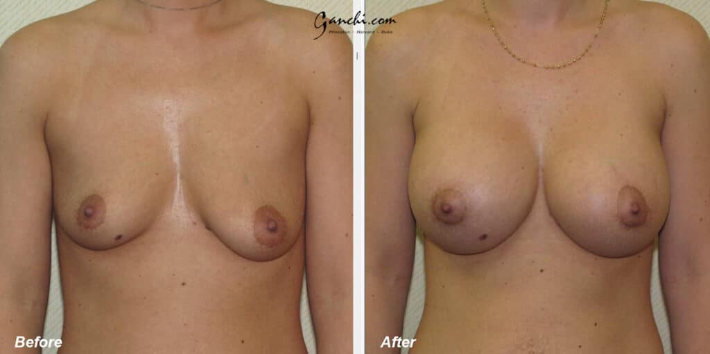 Breast Augmentation Before and After Photo by Ganchi Plastic Surgery in Northern New Jersey