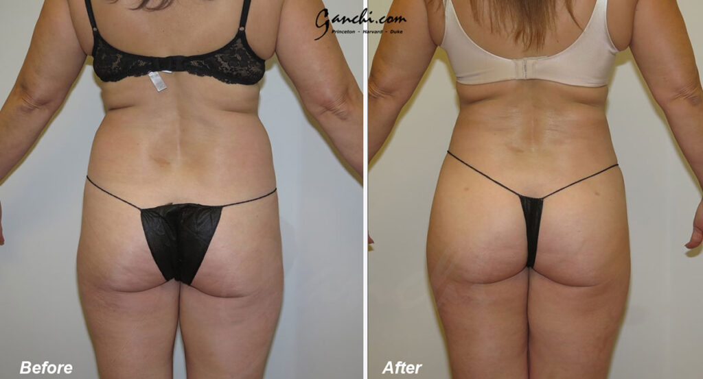 Liposuction Before and After Photo by Ganchi Plastic Surgery in Northern New Jersey