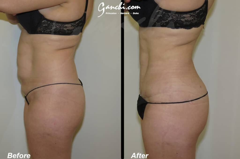 Tummy Tuck Before and After Photo by Ganchi Plastic Surgery in Northern New Jersey