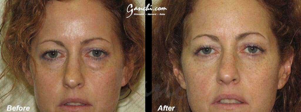 Eyelid Lift Before and After Photo by Ganchi Plastic Surgery in Northern New Jersey
