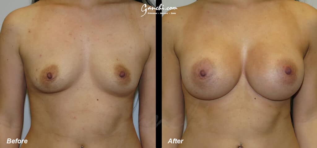 Breast Augmentation Before and After Photo by Ganchi Plastic Surgery in Northern New Jersey