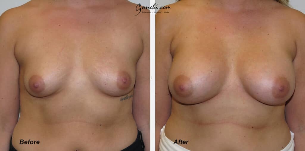 Breast Augmentation Before and After Photo by Ganchi Plastic Surgery in Northern New Jersey