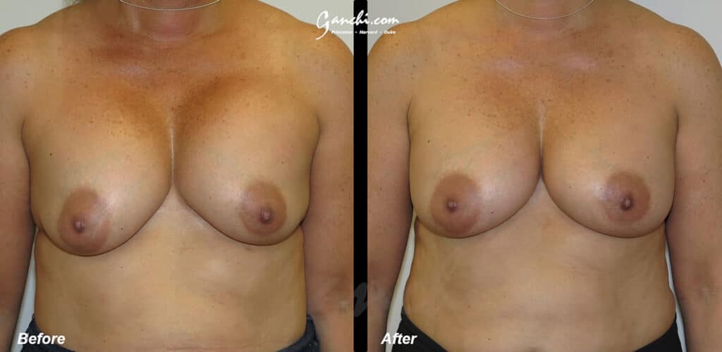 Breast Implant Revision Before and After Photo by Ganchi Plastic Surgery in Northern New Jersey