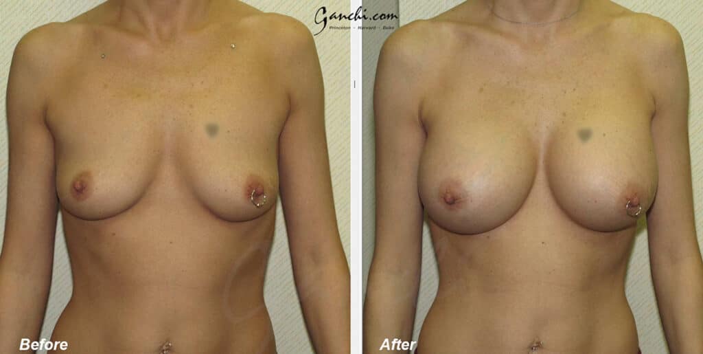 Breast Augmentation Before and After Photo by Ganchi Plastic Surgery in Northern New Jersey