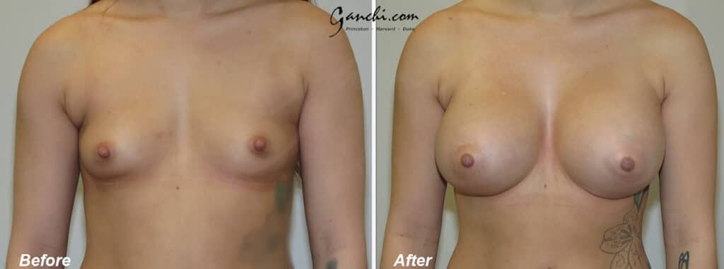 Breast Augmentation Before and After Photo by Ganchi Plastic Surgery in Northern New Jersey