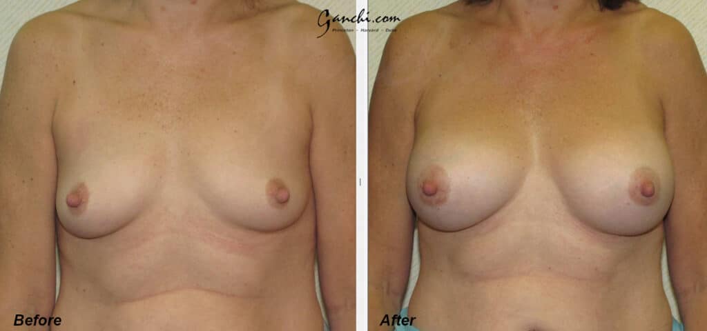Breast Augmentation Before and After Photo by Ganchi Plastic Surgery in Northern New Jersey