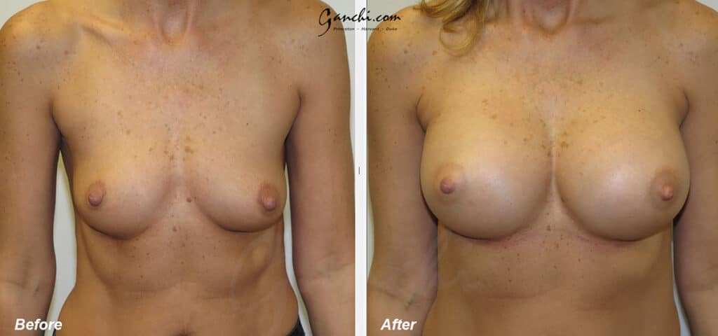 Breast Augmentation Before and After Photo by Ganchi Plastic Surgery in Northern New Jersey