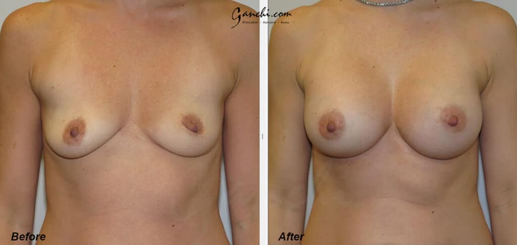 Breast Augmentation Before and After Photo by Ganchi Plastic Surgery in Northern New Jersey