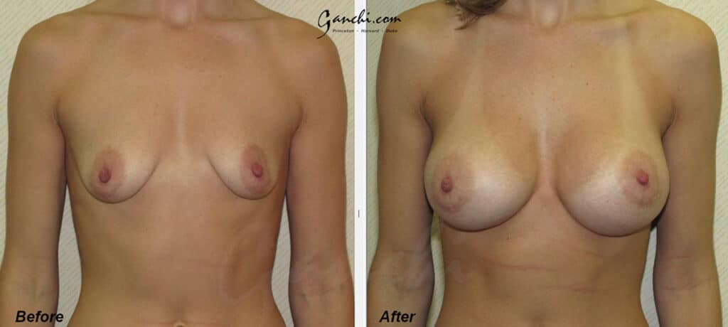 Breast Augmentation Before and After Photo by Ganchi Plastic Surgery in Northern New Jersey