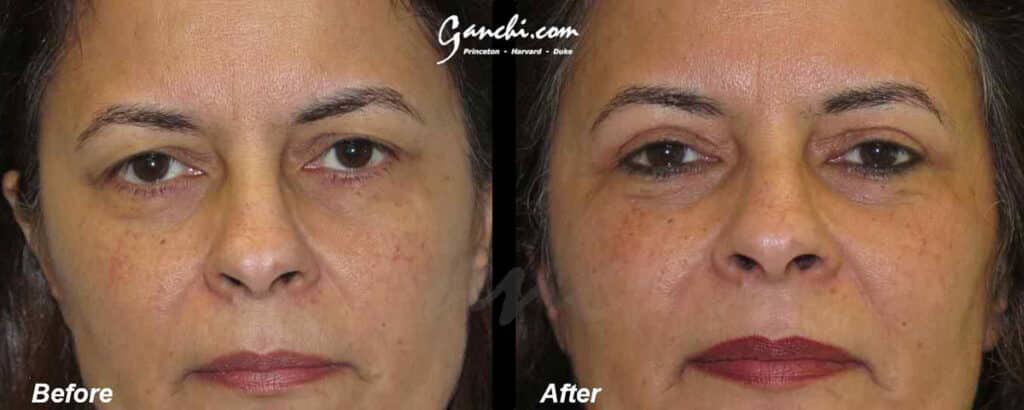 Eyelid Lift Before and After Photo by Ganchi Plastic Surgery in Northern New Jersey
