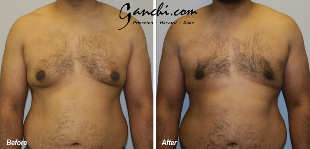 Gynecomastia Before and After Photo by Ganchi Plastic Surgery in Northern New Jersey
