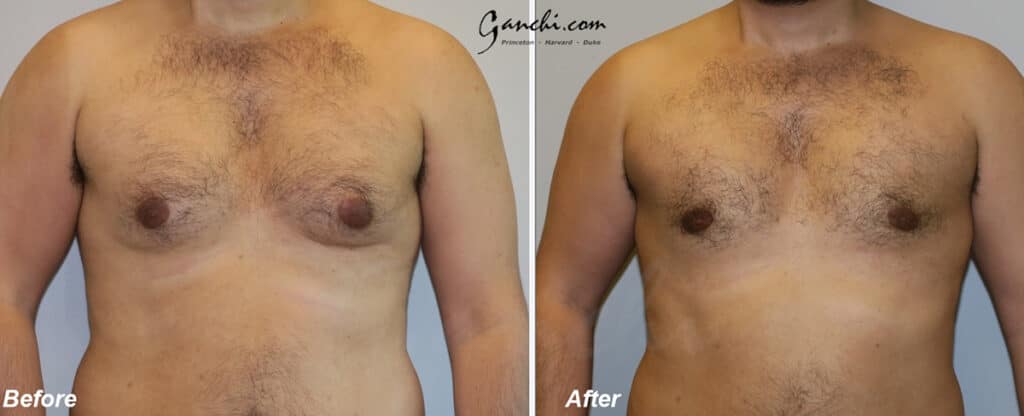 Gynecomastia Before and After Photo by Ganchi Plastic Surgery in Northern New Jersey