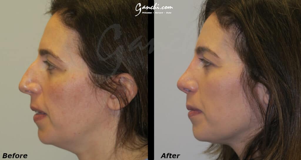 Rhinoplasty Before and After Photo by Ganchi Plastic Surgery in Northern New Jersey