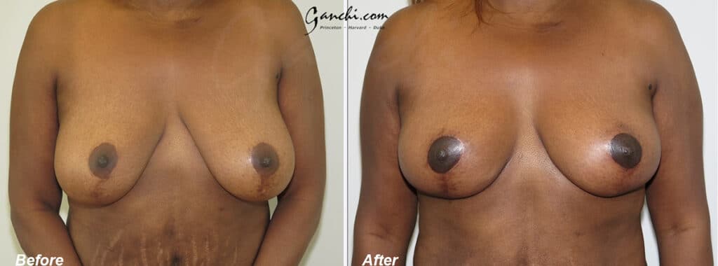 Breast Lift Before and After Photo by Ganchi Plastic Surgery in Northern New Jersey