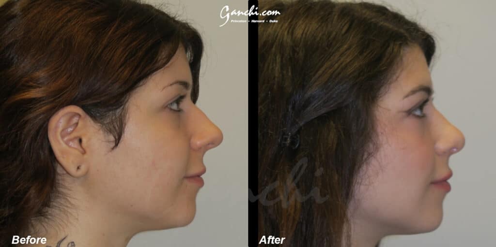 Rhinoplasty Before and After Photo by Ganchi Plastic Surgery in Northern New Jersey