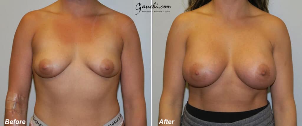 Breast Augmentation Before and After Photo by Ganchi Plastic Surgery in Northern New Jersey