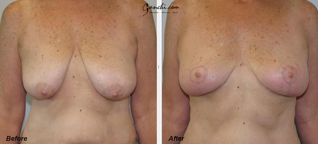 Breast Lift Before and After Photo by Ganchi Plastic Surgery in Northern New Jersey