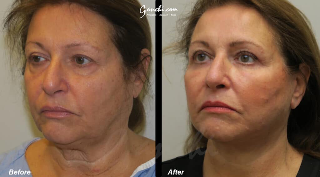 Face/Necklift Before and After Photo by Ganchi Plastic Surgery in Northern New Jersey