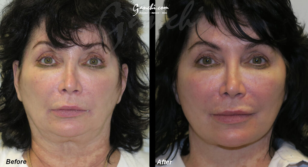 Face:Neck Lift Before and After Photo by Ganchi Plastic Surgery in Northern New Jersey