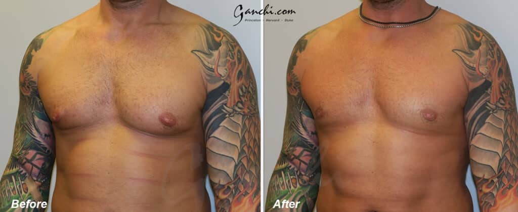 Gynecomastia Before and After Photo by Ganchi Plastic Surgery in Northern New Jersey
