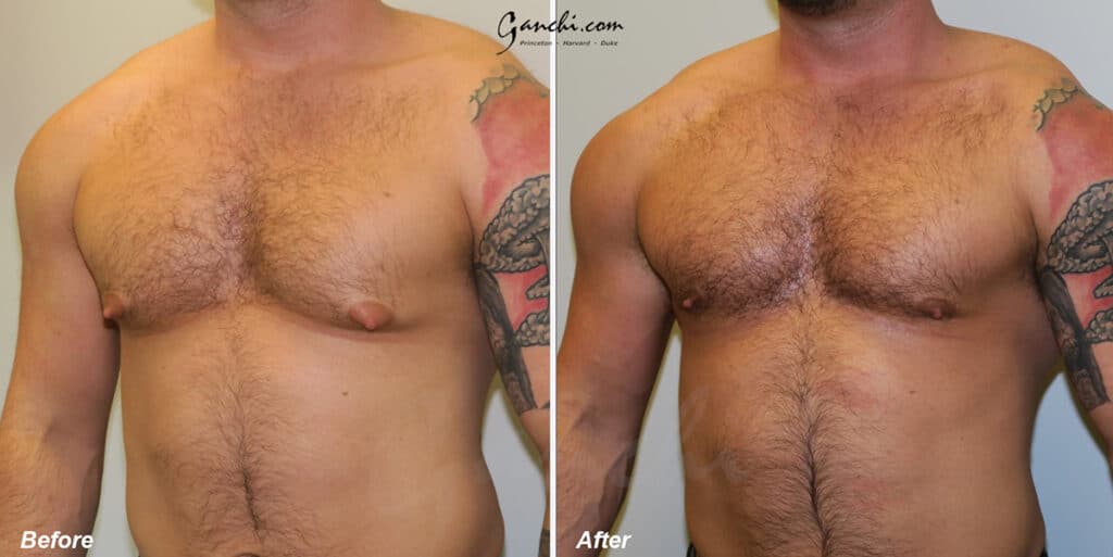Gynecomastia Before and After Photo by Ganchi Plastic Surgery in Northern New Jersey