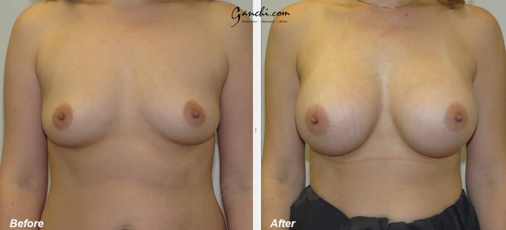Breast Augmentation Before and After Photo by Ganchi Plastic Surgery in Northern New Jersey