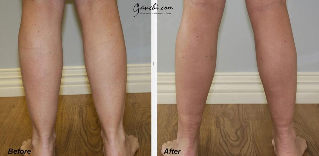 Calves Liposuction Before and After Photo by Ganchi Plastic Surgery in Northern New Jersey
