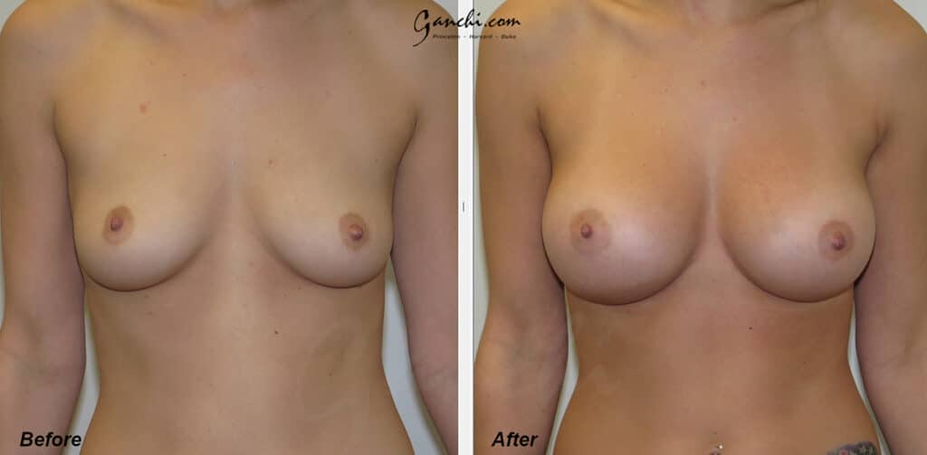 Breast Augmentation Before and After Photo by Ganchi Plastic Surgery in Northern New Jersey