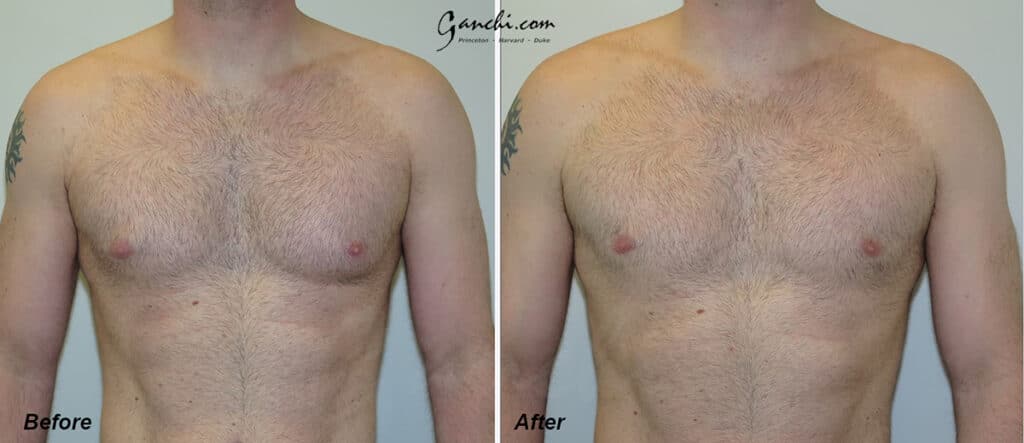 Gynecomastia Before and After Photo by Ganchi Plastic Surgery in Northern New Jersey
