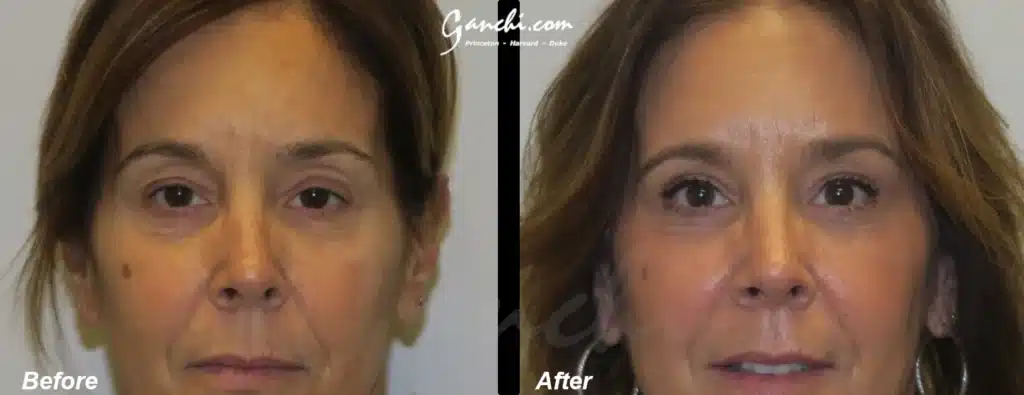 Eyelid Lift Before and After Photo by Ganchi Plastic Surgery in Northern New Jersey