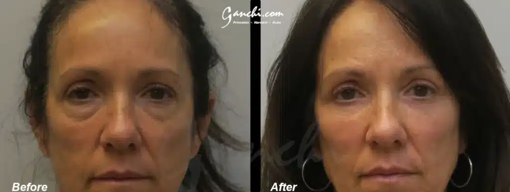 Eyelid Lift Before and After Photo by Ganchi Plastic Surgery in Northern New Jersey