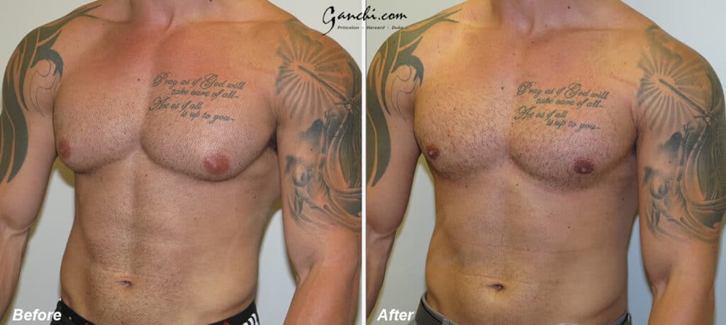 Gynecomastia Before and After Photo by Ganchi Plastic Surgery in Northern New Jersey