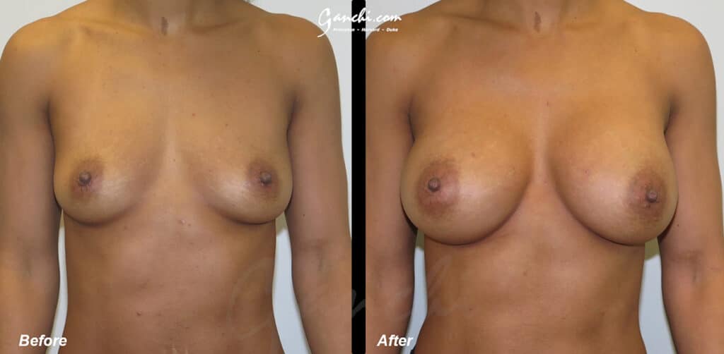 Breast Augmentation Before and After Photo by Ganchi Plastic Surgery in Northern New Jersey