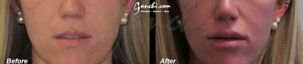 Lip Augmentation Before and After Photo by Ganchi Plastic Surgery in Northern New Jersey