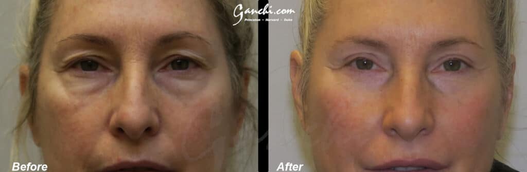 Eyelid Lift Before and After Photo by Ganchi Plastic Surgery in Northern New Jersey