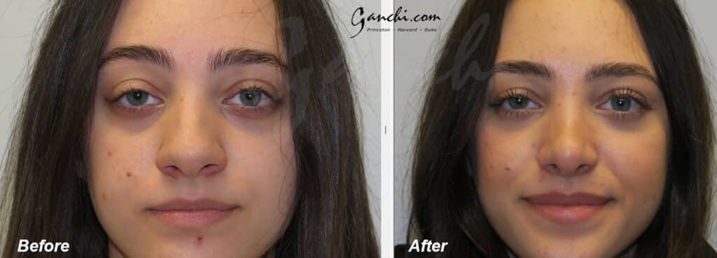Rhinoplasty Before and After Photo by Ganchi Plastic Surgery in Northern New Jersey