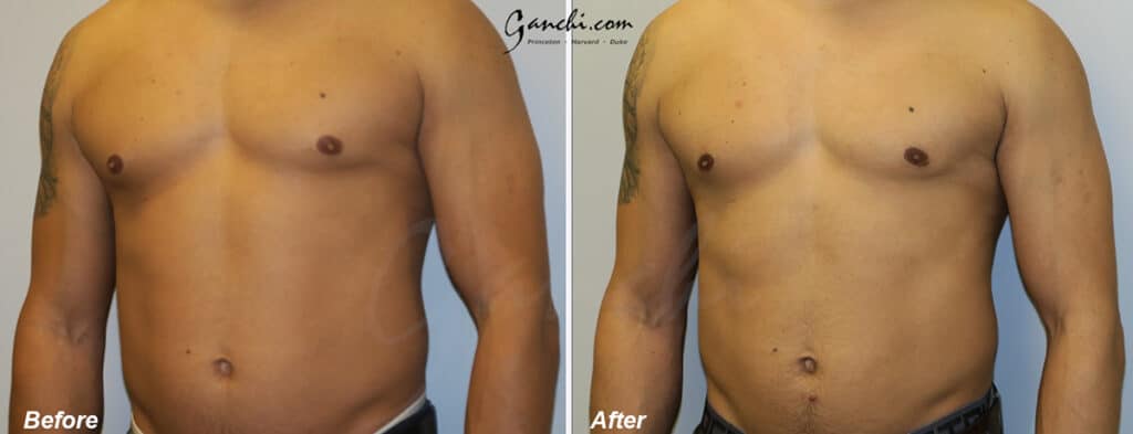 Gynecomastia Before and After Photo by Ganchi Plastic Surgery in Northern New Jersey