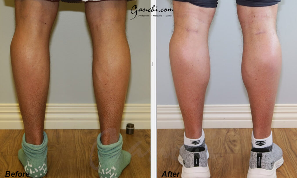 Calf Augmentation Before and After Photo by Ganchi Plastic Surgery in Northern New Jersey